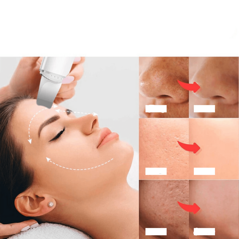 Esfoliador Ultrassônico de Pele: Removedor de Cravos e Limpador Facial com Cavitação